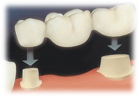 Dental Bridges