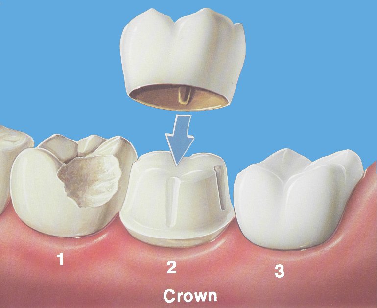 Sealants