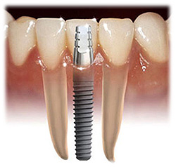 Dental Implants