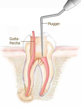 Root Canal